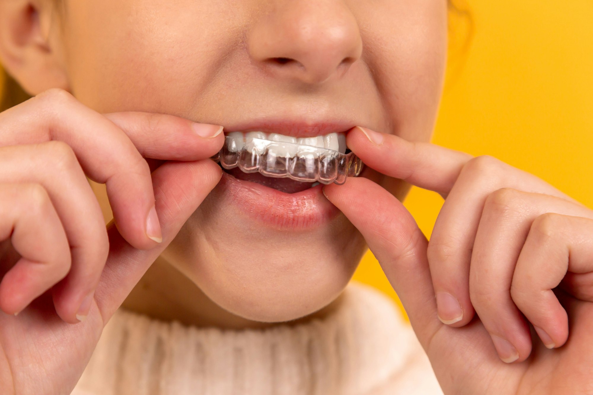 Porcelain veneers creating a beautiful, uniform smile